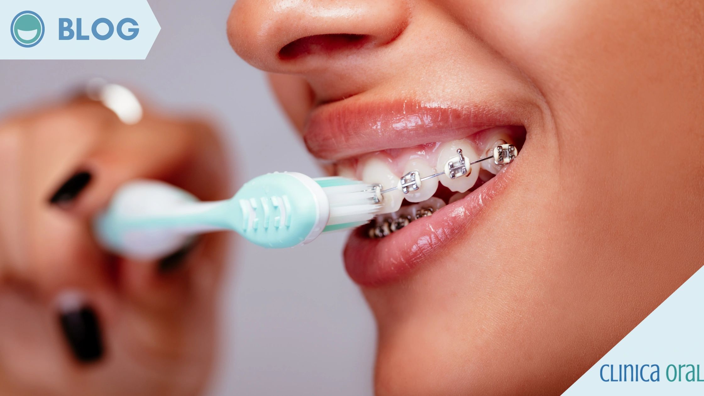 ¿Cómo cepillarse los dientes con Brackets correctamente?